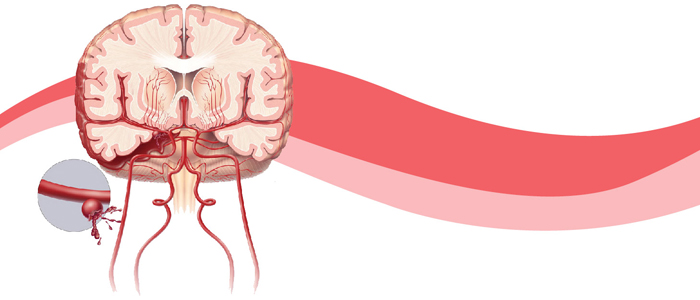 Aneurisma cerebral é conhecido por ser uma doença silenciosa