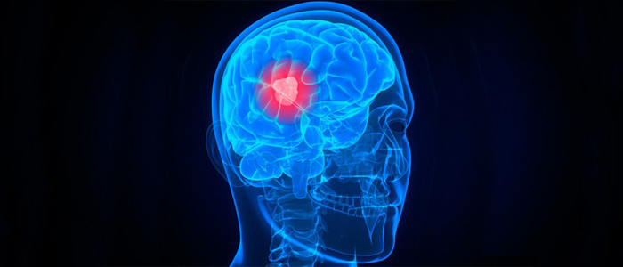 Gliobastoma é o tipo mais comum de tumor cerebral maligno