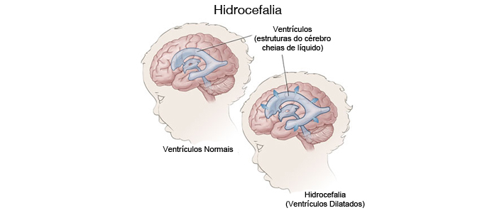 Doenças que a neurocirurgia pediátrica pode tratar