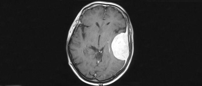 Meningioma cerebral cresce sem apresentar sintomas