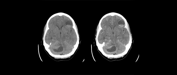 Saiba o que é a metástase cerebral