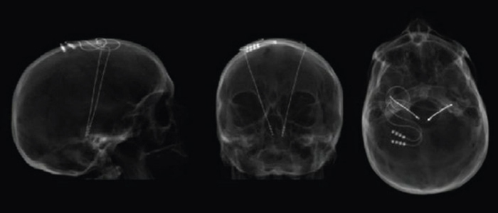 As doenças que a neurocirurgia funcional pode tratar