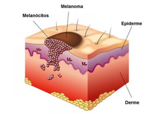 cancer-de-pele-melanoma-300x225