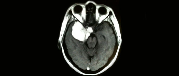 Meningioma cerebral é o tumor que cresce a partir das meninges