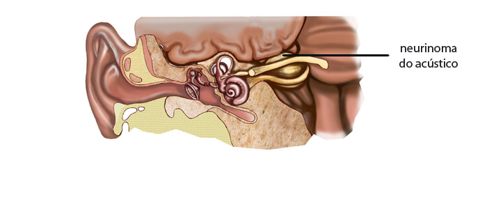 Neurinoma do acústico pode causar perda de equilíbrio e de audição