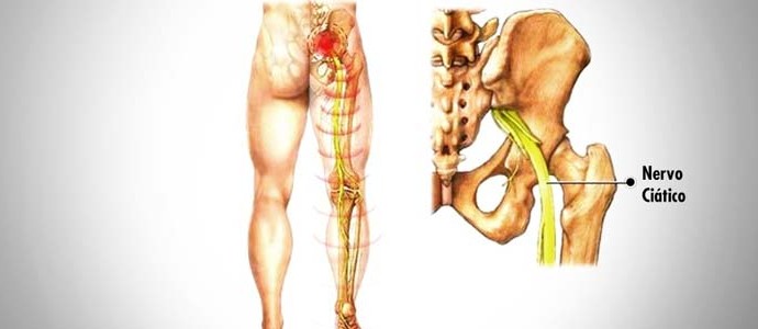 Saiba como evitar dores no nervo ciático